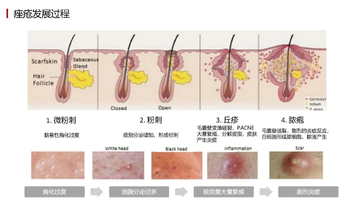 痘痘该如何去除效果好-了解成因科学祛痘